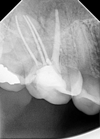 After root canal treatment