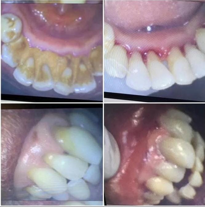 After scaling and polishing